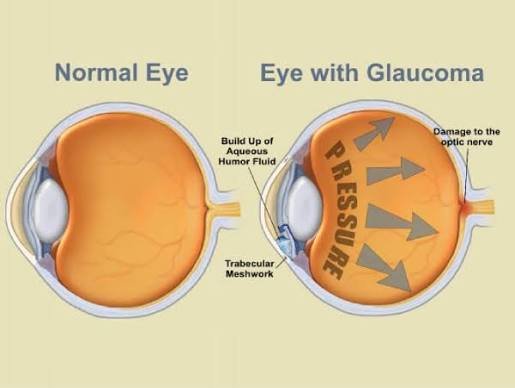 Eye Surgery Consultation